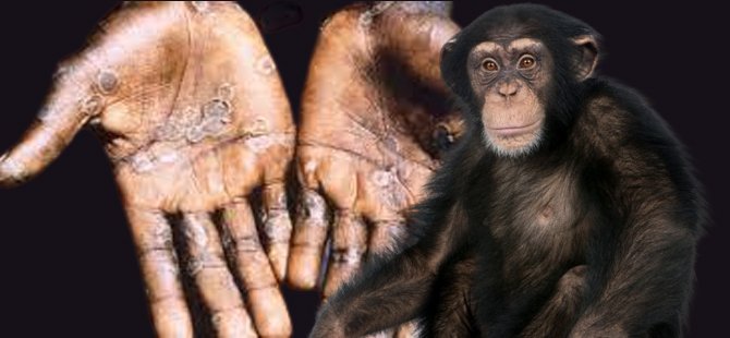 Maymun Çiçeği Virüsü Monkeypox Hakkında Bilmeniz Gerekenler